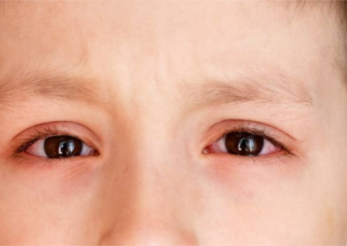 triệu chứng mới của COVID-19: ngứa mắt và đau mắt đỏ