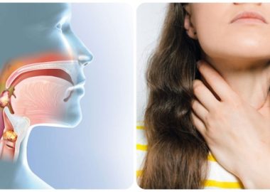 6 dấu hiệu sớm của ung thư vòm họng