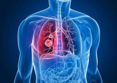 Tầm soát ung thư phổi và các bệnh lý liên quan