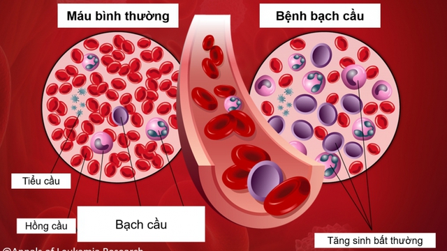 Biểu hiện của ung thư máu