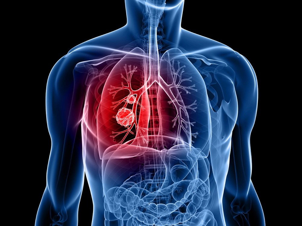 tầm soát ung thư phổi