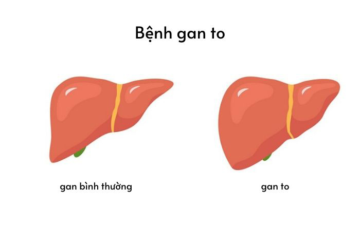 Gan to có nguy hiểm không