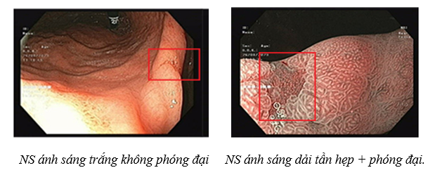 nội soi tiêu hóa chuẩn Nhật