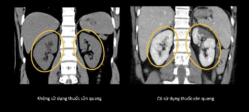 Hai ảnh trên là hai ảnh chụp CT hai quả thận, thể hiện sự khác biệt giữa chụp CT không sử dụng thuốc cản quang và có sử dụng thuốc cản quang