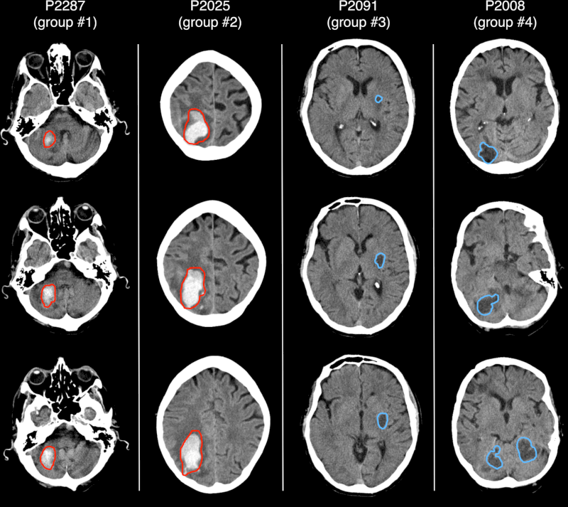 Hình ảnh chụp CT phát hiện tự động các tổn thương não, phần khoanh màu đỏ là vùng xuất huyết não và phần khoanh màu xanh là vùng thiếu máu não. Nguồn: Sciencedirect
