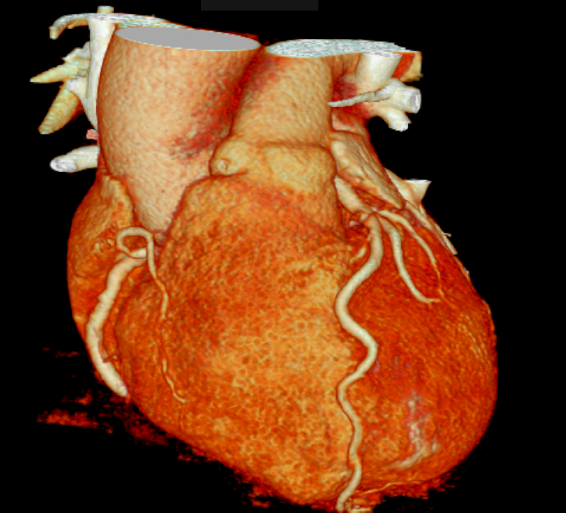 Hình ảnh kết quả chụp CT mạch vành