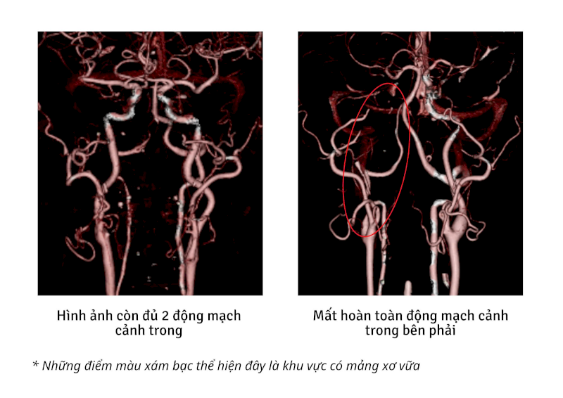 Hình ảnh minh họa chụp MRI động mạch cảnh phát hiện bất thường