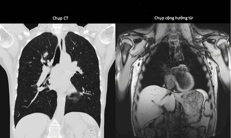 Hình ảnh thể hiện sự khác biệt giữa kết quả chụp CT và chụp cộng hưởng từ ở cùng một vị trí