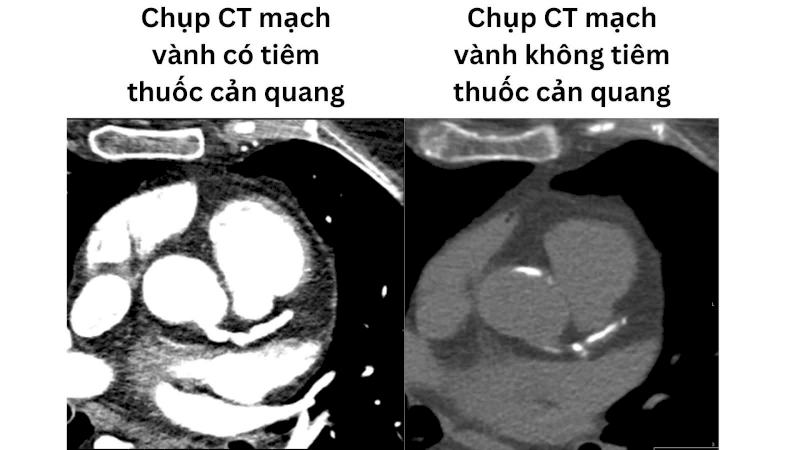 Hình ảnh thể hiện sự khác biệt trong kết quả của hai phương pháp chụp CT mạch vành