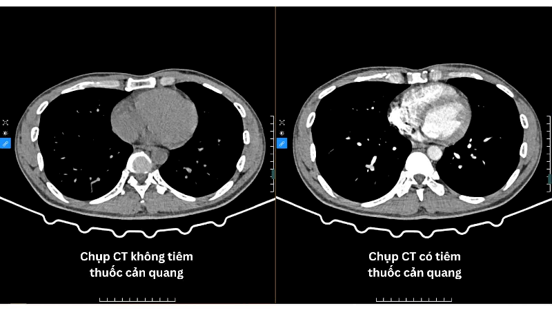 Hình ảnh trên thể hiện sự tác động của thuốc cản quang lên kết quả chụp CT