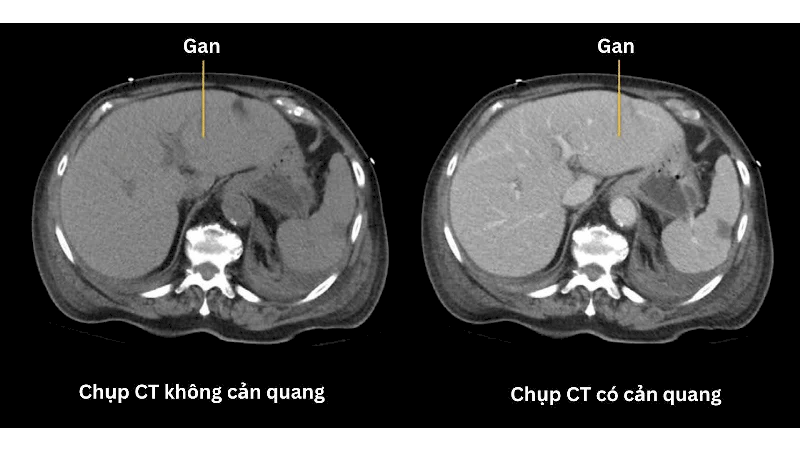 Kết quả chụp CT gan, với hình bên trái là khi chụp CT không thuốc cản quang và hình bên phải là khi chụp CT có thuốc cản quang