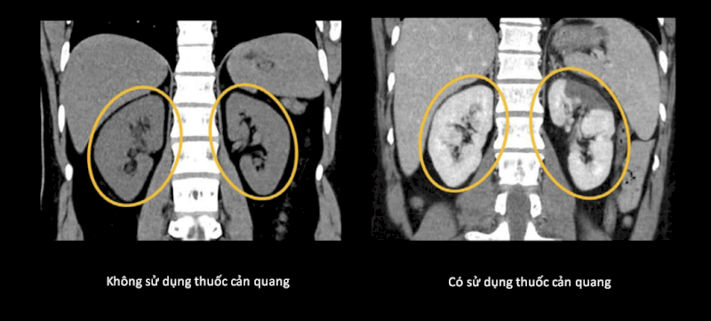 Sự khác biệt giữa hình ảnh chụp CT không sử dụng thuốc cản quang và có sử dụng thuốc cản quang