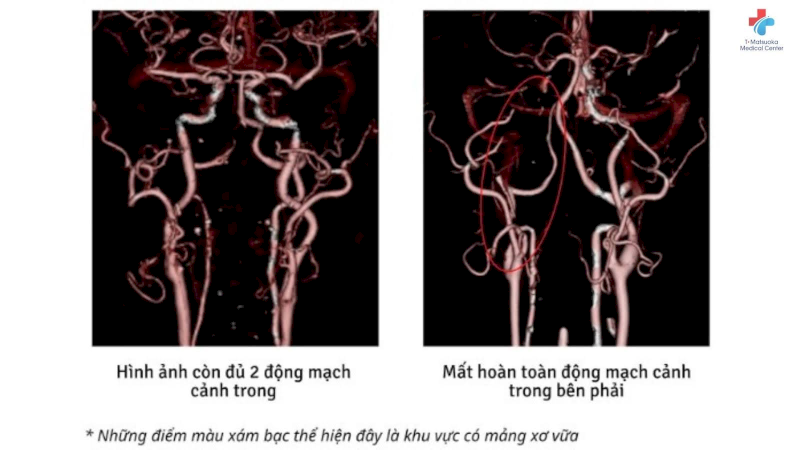 Hình ảnh kết quả chụp cộng hưởng từ so sánh tình trạng của động mạch cảnh trong