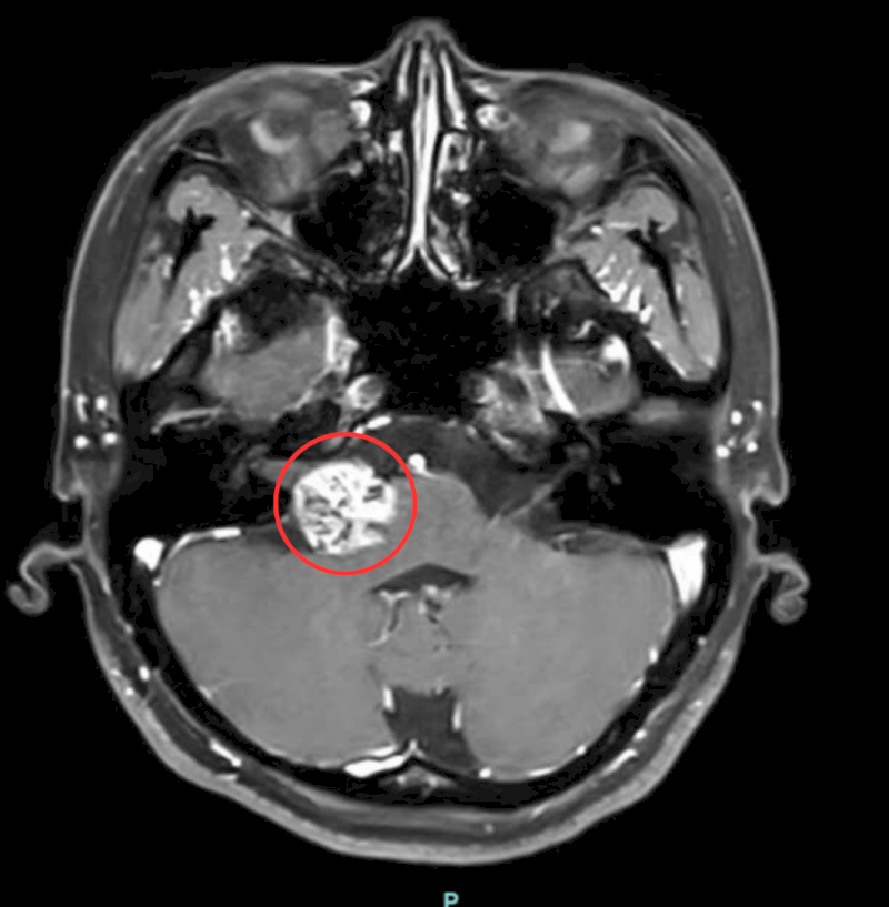 Bác sĩ phát hiện khối u não trên phim chụp MRI sọ não có tiêm thuốc