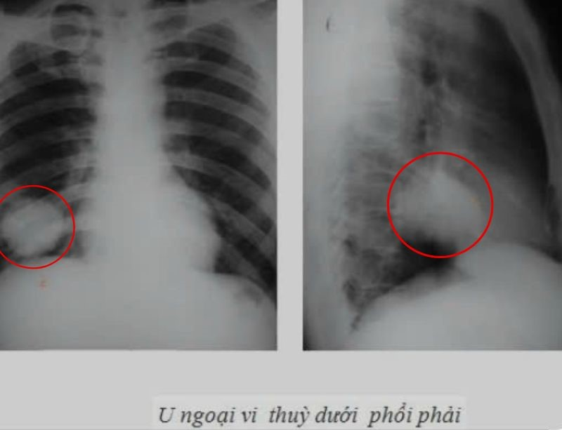 Chụp X-quang có thể phát hiện khối u ở phổi
