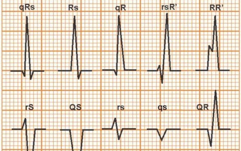 Các hình dạng của phức bộ QRS trên điện tâm đồ