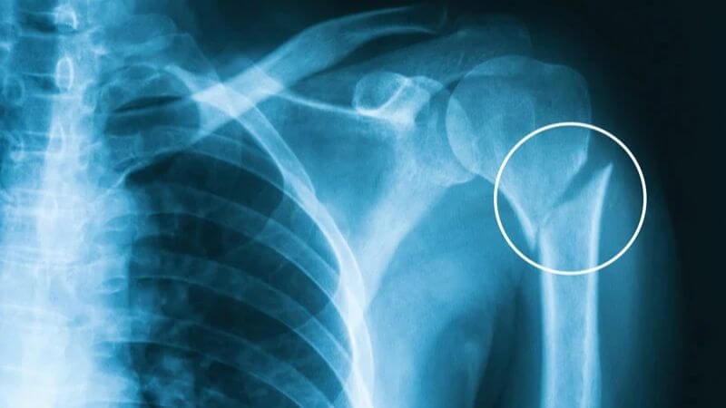 Gãy xương là một trong những trường hợp được chỉ định chụp X-quang tay