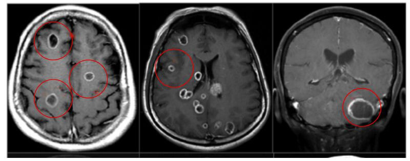 Hình ảnh di căn não trên MRI với nhiều ổ kích thước khác nhau