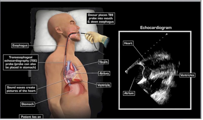 Hình ảnh siêu âm tim qua đường thực quản