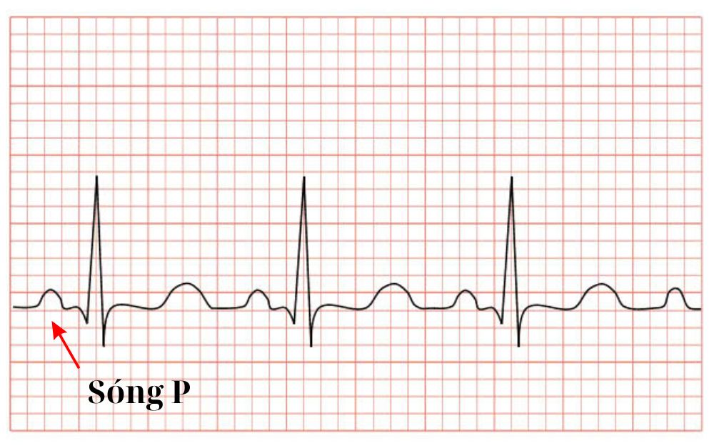 Hình dạng của sóng P trên điện tâm đồ