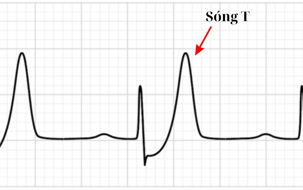Hình dạng của sóng T trên điện tâm đồ