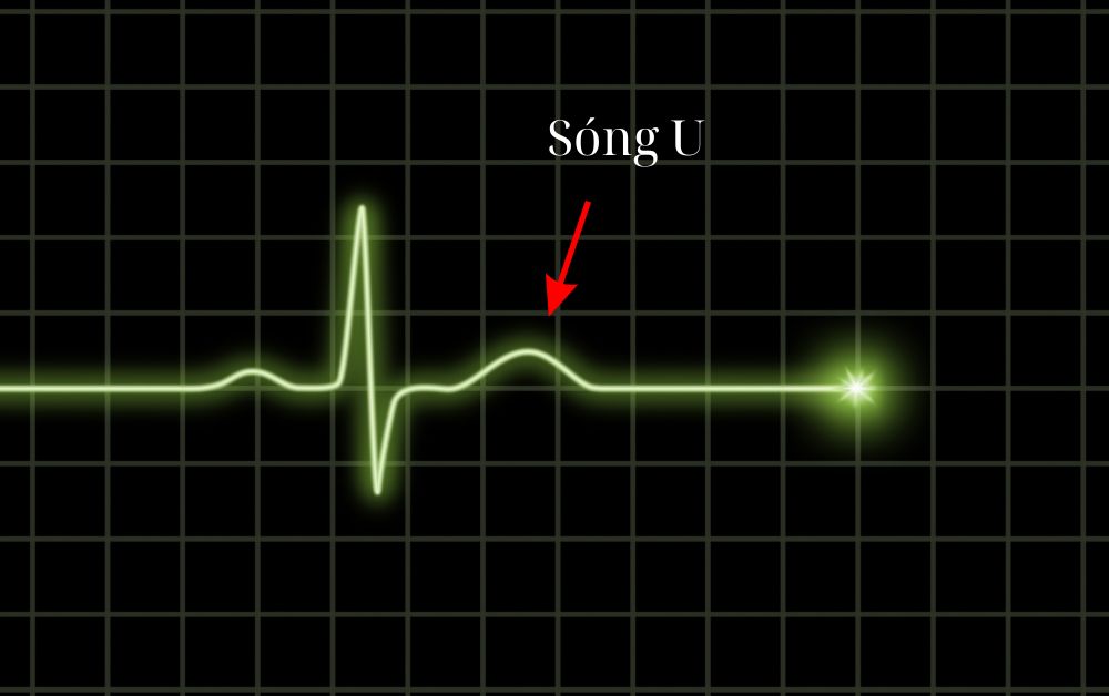 Hình dạng của sóng U trên điện tâm đồ