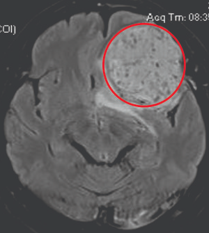 Khối tổn thương nghi ngờ u não trên phim chụp MRI não