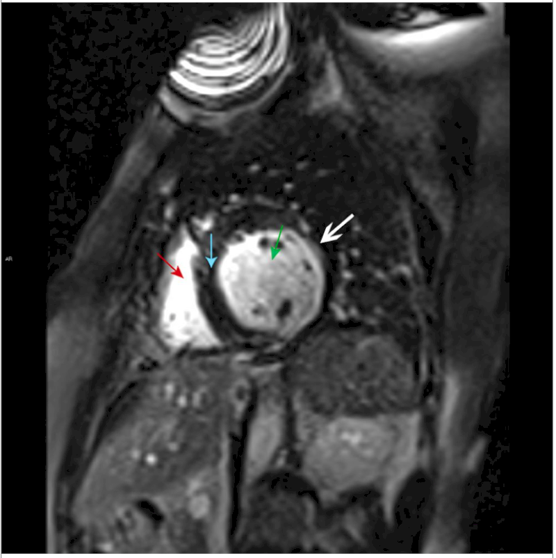 MRI tim này cho thấy tâm thất phải (mũi tên màu đỏ) và tâm thất trái (mũi tên màu xanh lá cây) được ngăn cách bởi cơ tim vách ngăn (mũi tên màu xanh lam). Có đặc điểm tăng cường gadolinium dưới cơ tim muộn của một nhồi máu cơ tim nhỏ ở thành bên của tâm thất trái (mũi tên trắng).