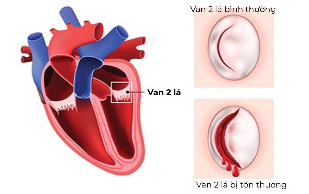 So sánh cấu trúc van hai lá ở trạng thái bình thường và khi bị tổn thương