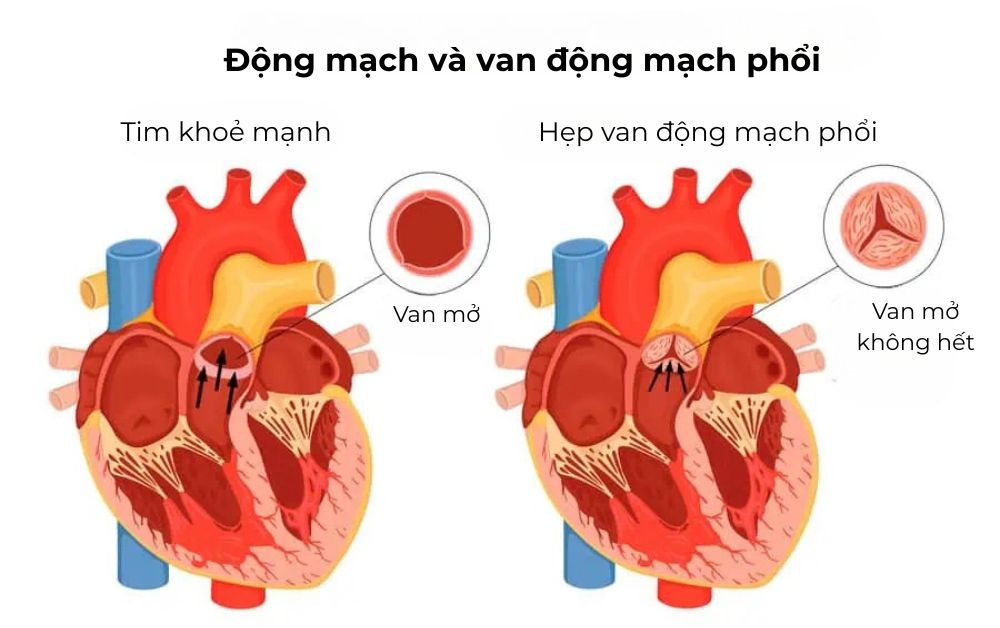So sánh hoạt động van động mạch phổi bình thường và khi bị hẹp