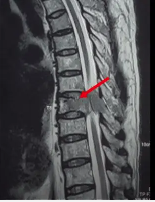 Tổn thương cột sống ngực trên phim MRI (mũi tên đỏ)