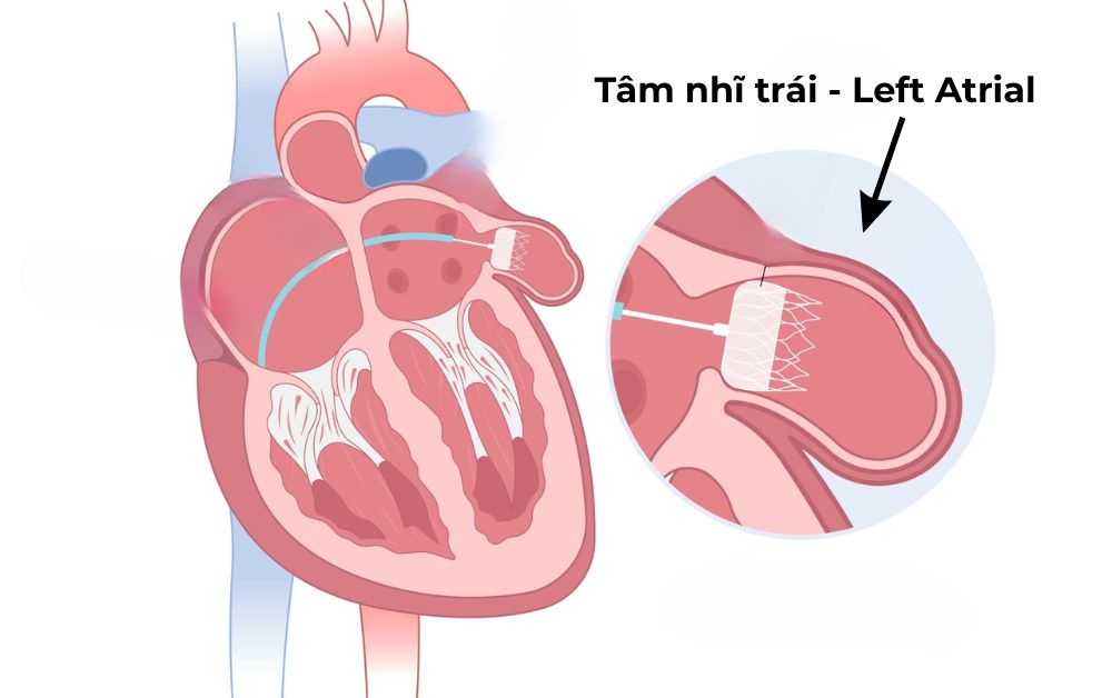 Vị trí và cấu trúc của tâm nhĩ trái trong buồng tim