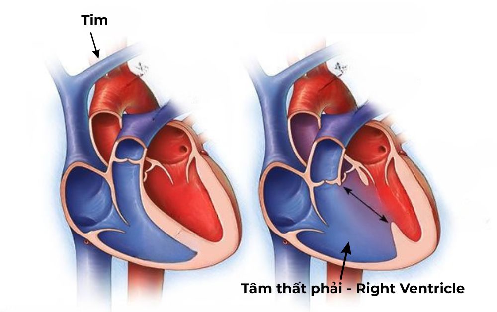 Vị trí và cấu trúc của tâm thất phải trong buồng tim