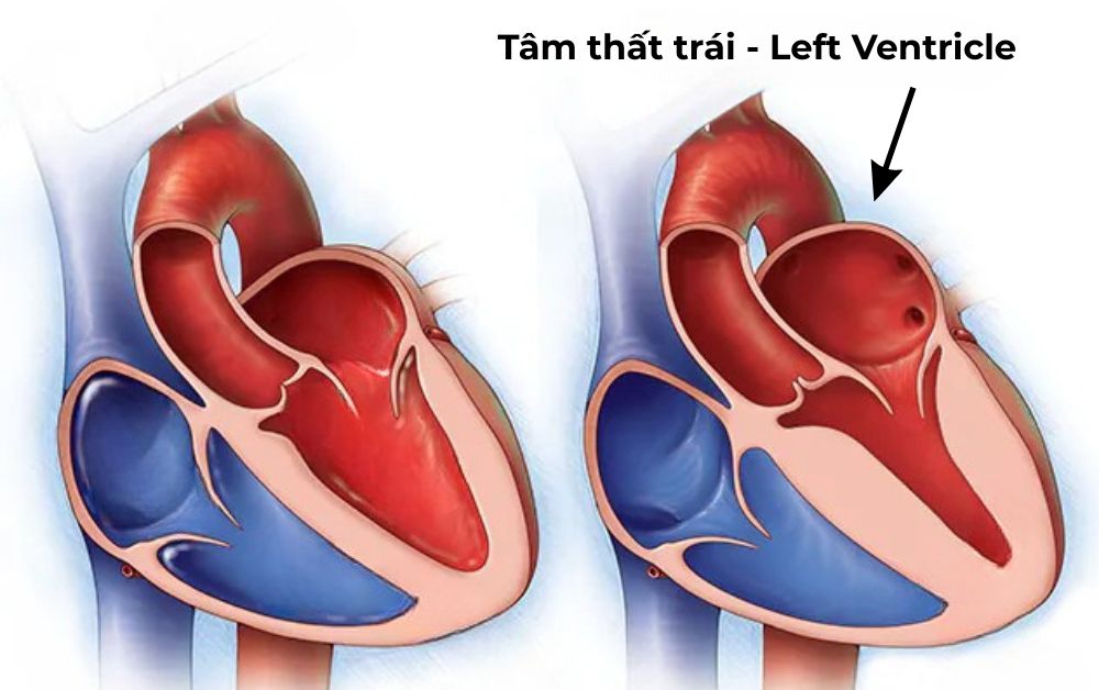 Vị trí và cấu trúc của tâm thất trái trong buồng tim